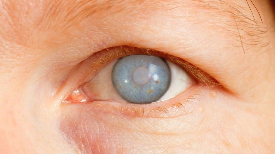 What is Glaucoma and How Does it Affect Vision?