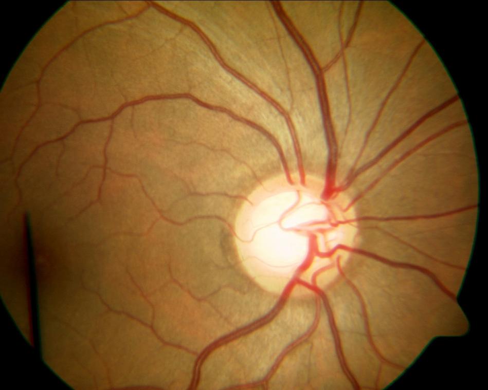 How Can I Prevent Glaucoma?